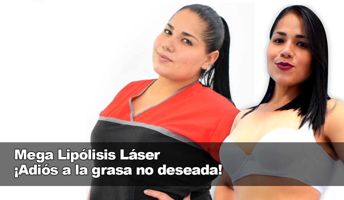La Mega Lipólisis Láser, la solución efectiva para deshacerse de la grasa no deseada